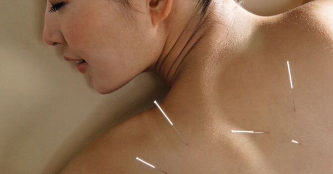 How Does Acupuncture Work? Benefits, Pain Relief, and What to Expect image
